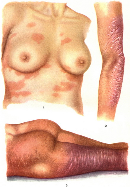 ретикулез кожи